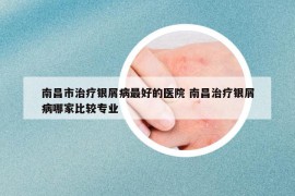 南昌市治疗银屑病最好的医院 南昌治疗银屑病哪家比较专业