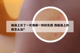 脑袋上长了一片像癣一样的东西 我脑袋上的癣怎么治?