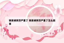 银屑病突然严重了 银屑病突然严重了怎么回事