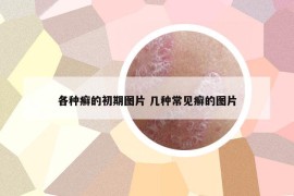 各种癣的初期图片 几种常见癣的图片