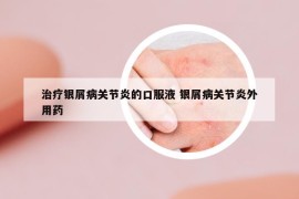 治疗银屑病关节炎的口服液 银屑病关节炎外用药