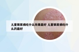 儿童银屑病吃什么效果最好 儿童银屑病吃什么药最好