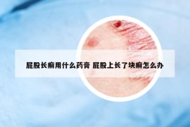 屁股长癣用什么药膏 屁股上长了块癣怎么办