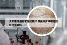 贵阳银屑病哪家医院最好 贵阳银屑病研究院能治得好吗