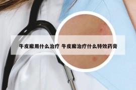 牛皮廨用什么治疗 牛皮廨治疗什么特效药膏