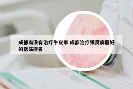 成都有没有治疗牛皮癣 成都治疗银屑病最好的医生排名