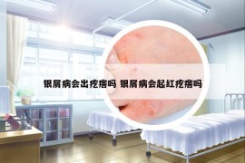 银屑病会出疙瘩吗 银屑病会起红疙瘩吗