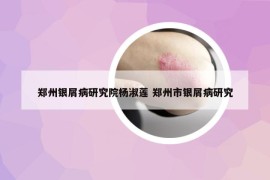 郑州银屑病研究院杨淑莲 郑州市银屑病研究