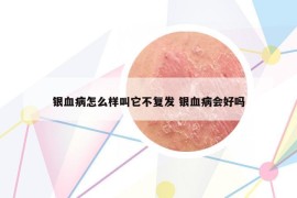 银血病怎么样叫它不复发 银血病会好吗