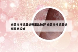 南昌治疗银屑病哪里比较好 南昌治疗银屑病哪里比较好