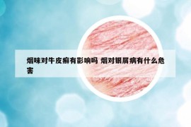 烟味对牛皮癣有影响吗 烟对银屑病有什么危害