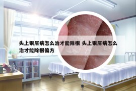 头上银屑病怎么治才能除根 头上银屑病怎么治才能除根偏方