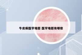 牛皮癣医学难题 医学难题有哪些