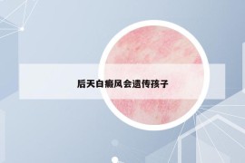 后天白癜风会遗传孩子