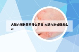 大腿内测长藓用什么药膏 大腿内测长藓怎么办