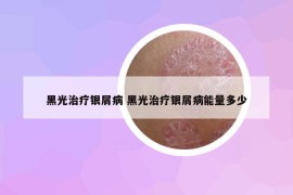 黑光治疗银屑病 黑光治疗银屑病能量多少