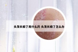 头发长癣了用什么药 头发长癣了怎么办