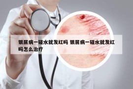 银屑病一碰水就发红吗 银屑病一碰水就发红吗怎么治疗