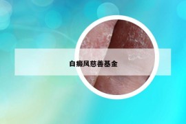 白癜风慈善基金