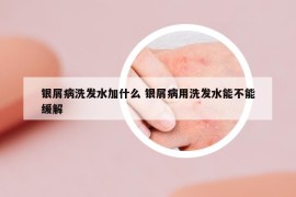 银屑病洗发水加什么 银屑病用洗发水能不能缓解