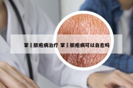 掌砋脓疱病治疗 掌砳脓疱病可以自愈吗