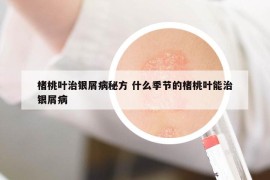 楮桃叶治银屑病秘方 什么季节的楮桃叶能治银屑病