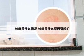 长癣是什么情况 长癣是什么原因引起的