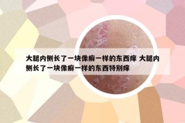 大腿内侧长了一块像癣一样的东西痒 大腿内侧长了一块像癣一样的东西特别痒