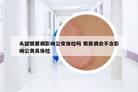 头部银屑病影响公安体检吗 银屑病会不会影响公务员体检