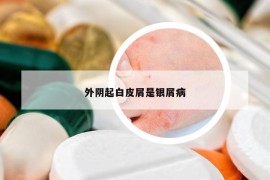 外阴起白皮屑是银屑病