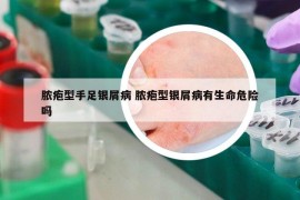 脓疱型手足银屑病 脓疱型银屑病有生命危险吗