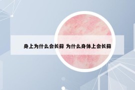 身上为什么会长藓 为什么身体上会长藓