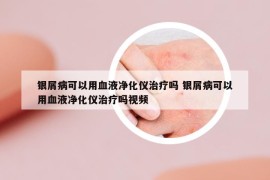 银屑病可以用血液净化仪治疗吗 银屑病可以用血液净化仪治疗吗视频