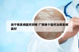 南宁银屑病医院到哪 广西哪个医院治银屑病最好