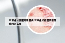 石家庄长征医院银屑病 石家庄长征医院银屑病科怎么样