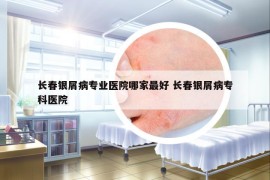 长春银屑病专业医院哪家最好 长春银屑病专科医院