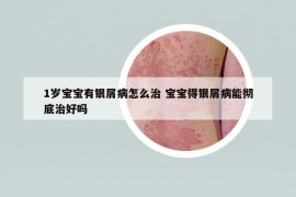 1岁宝宝有银屑病怎么治 宝宝得银屑病能彻底治好吗