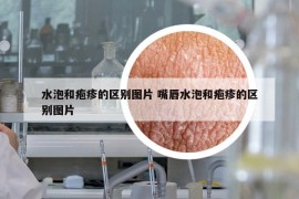 水泡和疱疹的区别图片 嘴唇水泡和疱疹的区别图片