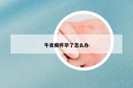 牛皮癣怀孕了怎么办