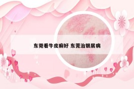 东菀看牛皮癣好 东莞治银屑病