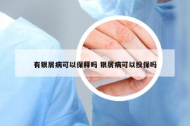 有银屑病可以保释吗 银屑病可以投保吗