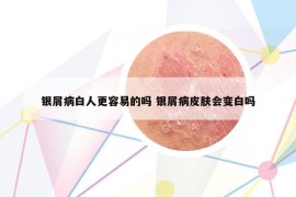 银屑病白人更容易的吗 银屑病皮肤会变白吗