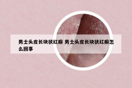 男士头皮长块状红癣 男士头皮长块状红癣怎么回事