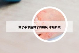 做了手术后得了白癜风 术后白斑