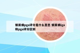 银屑病pga评分是什么意思 银屑病iga和pga评分区别