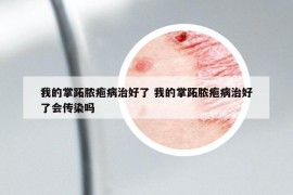 我的掌跖脓疱病治好了 我的掌跖脓疱病治好了会传染吗