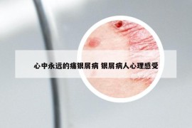 心中永远的痛银屑病 银屑病人心理感受