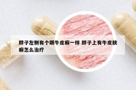 脖子左侧有个跟牛皮癣一样 脖子上有牛皮肤癣怎么治疗