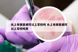 头上有银屑病可以上军校吗 头上有银屑病可以上军校吗男