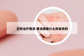 怎样治疗银消 银消病是什么样症状的